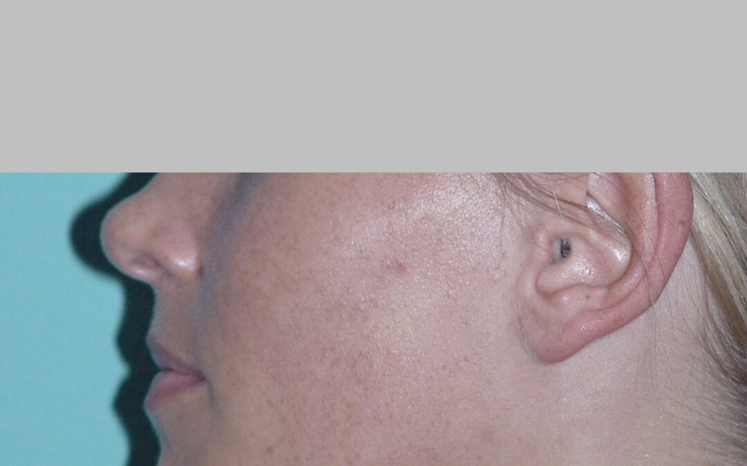 Nose tip correction – a medical or cosmetic procedure?