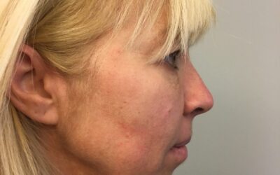 Why fillers usually don’t help with a wrinkled neck, and why neck wrinkles require a separate solution